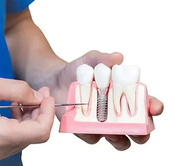 Implantatbehandling | Oslo Tannlegesenter