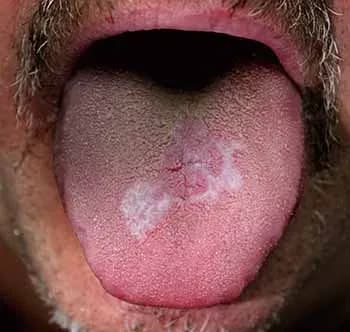 Oral lichen planus | Oslo Tannlegesenter