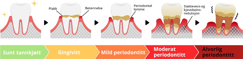Gingivitt | symptomer, behandling og prognose | Oslo Tannlegesenter