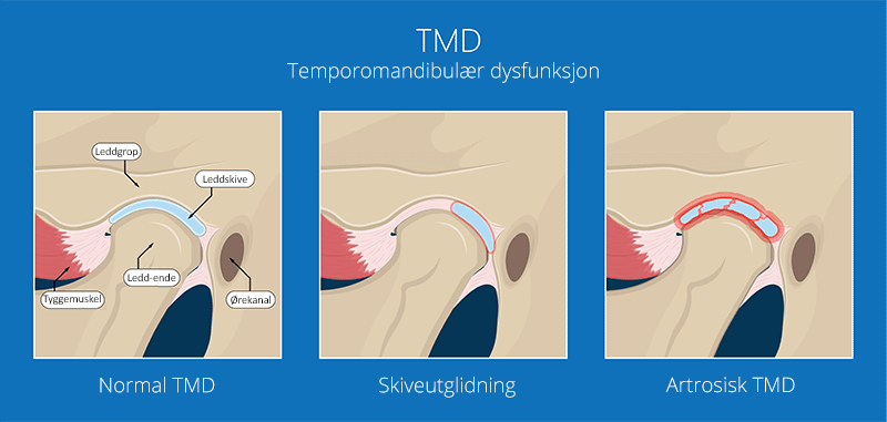 TMD | TMJ | Tmporo Mandibular Kjeveleddsmerte | Oslo Tannlegesenter