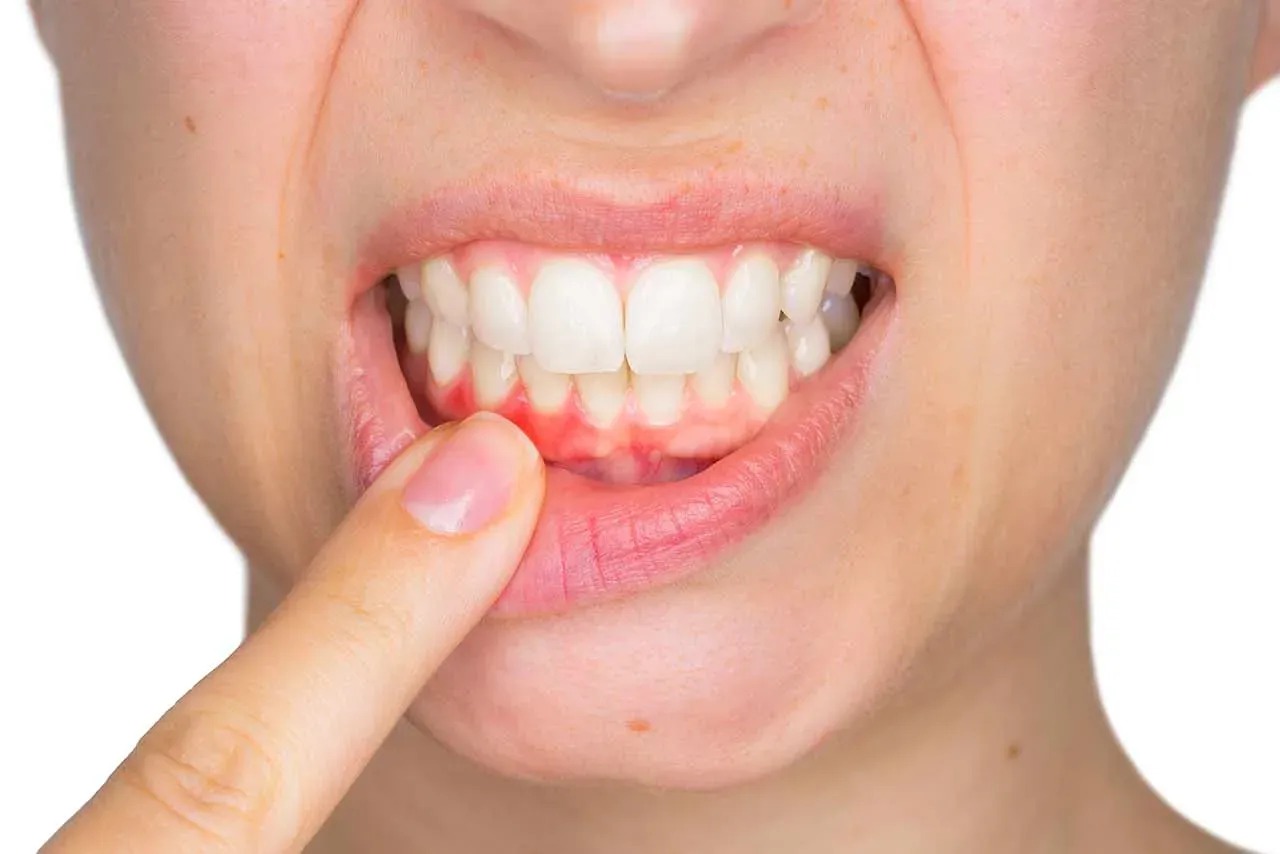 Gingivitt | symptomer, behandling og prognose | Oslo Tannlegesenter