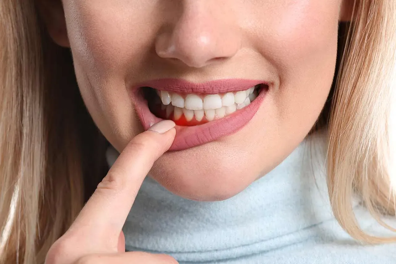 Periodontitt | symptomer, behandling og prognose | Oslo Tannlegesenter