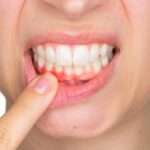 Gingivitt