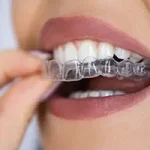 Invisalign