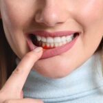 Periodontitt